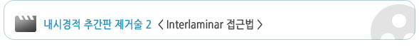 ���ð��� �߰��� ���ż� 2 <Interlaminar ���ٹ�>